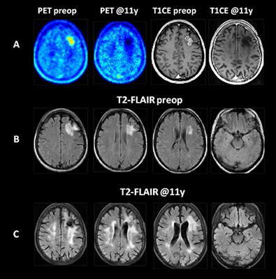 Case Report: Disruption of Resting-State Networks and Cognitive Deficits After Whole Brain Irradiation for Singular Brain Metastasis